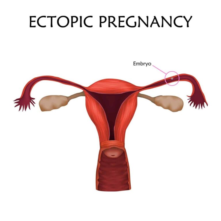 Ovarian Ectopic Pregnancy: Symptoms and Emergency Signs
