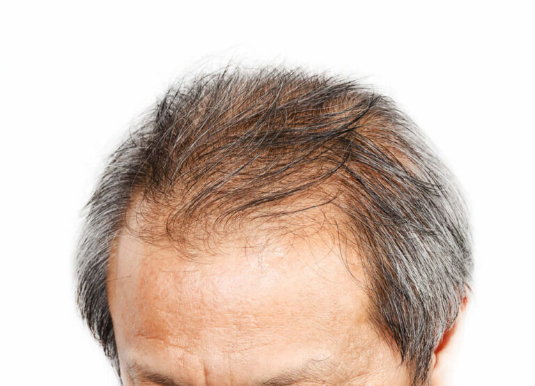 Why Many Men Experience Hair Thinning Earlier Than Expected